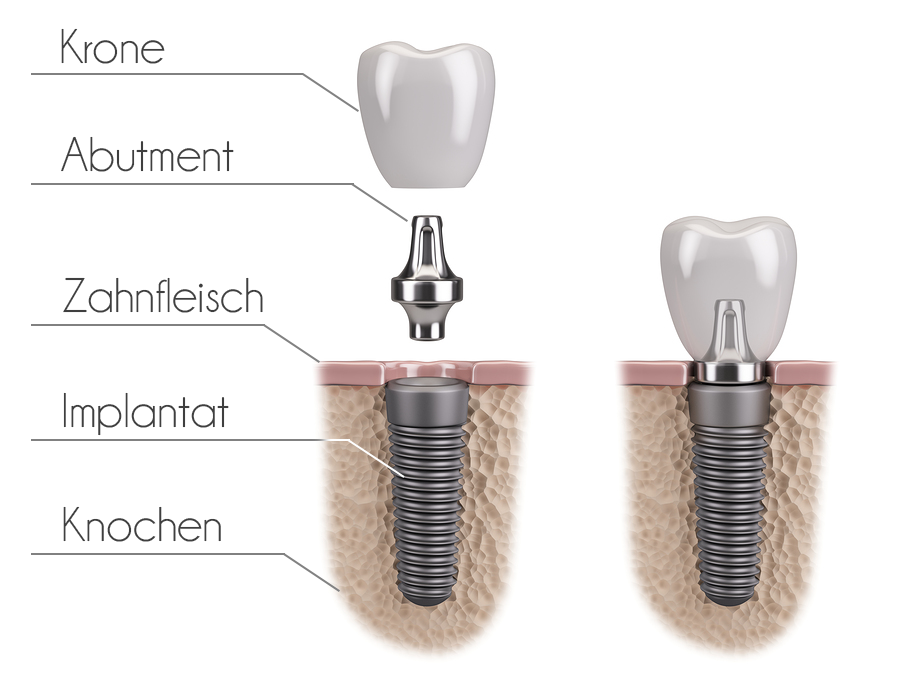bigstock-Tooth-human-implant-117269126