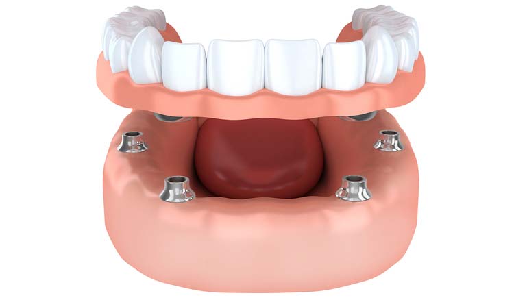 Modell 6 Zahnimplantate tragen festen Zahnersatz