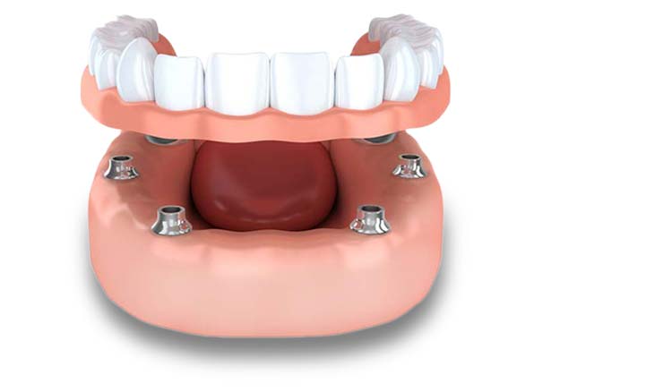 Modell 6 Zahnimplantate tragen festen Zahnersatz