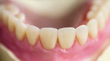 Festsitzender Zahnersatz auf Implantaten